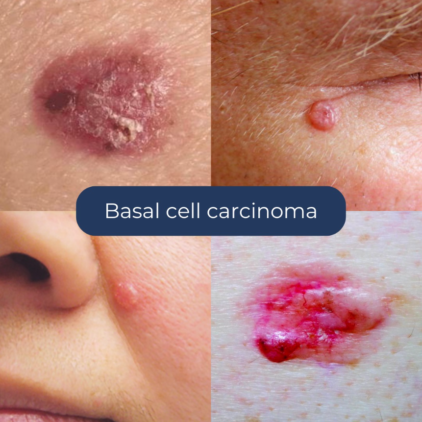 Skin Cancer Information - Rose Clinic
